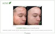 Severe Acne Treated with ViPeels at SpaGo MedSpa