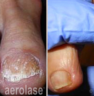 Nail Fungus ab before and after | Spago MedSpa in Erie, PA