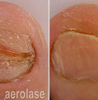 Medspa Gallery Nail Fungus ab | Spago MedSpa in Erie, PA