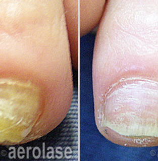 Medspa Gallery Nail Fungus | Spago MedSpa in Erie, PA