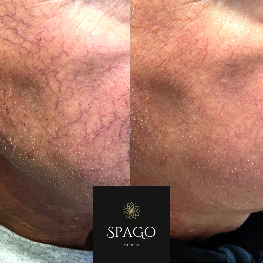 MedSpa Rosacea Treatments | Spago MedSpa in Erie, PA