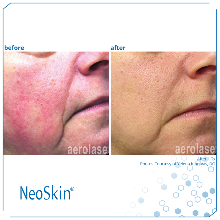 Rosacea Before And After 2nd | Spago MedSpa in Erie, PA