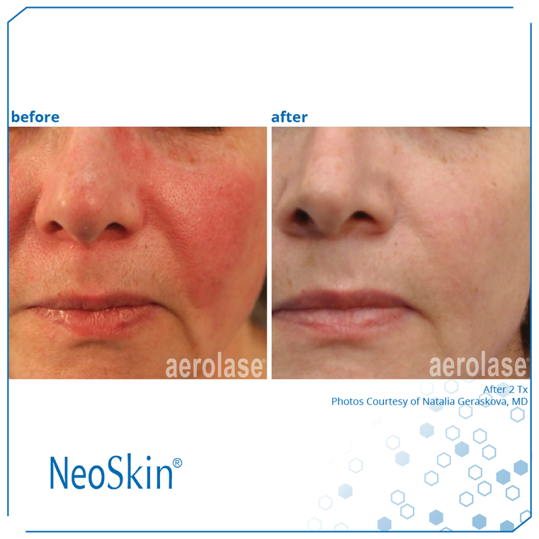 Rosacea Before And After | Spago MedSpa in Erie, PA