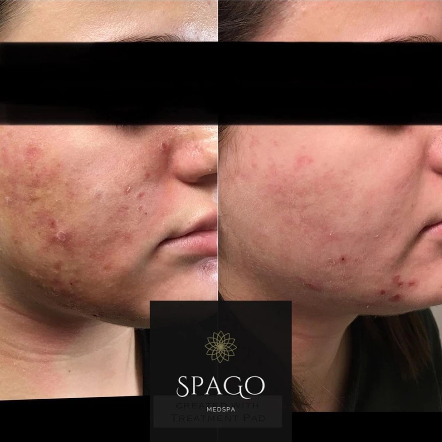 Female Acne Scar Before and After Treatments Photo | SpaGo MedSpa in Erie, PA