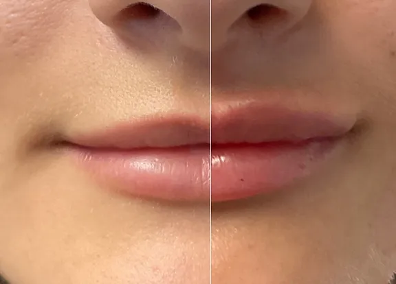Lip Filler Before & After Photo | SpaGo MedSpa in Erie, PA.