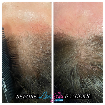 Hair Restorations Before and After Treatments Photo | SpaGo MedSpa in Erie, PA
