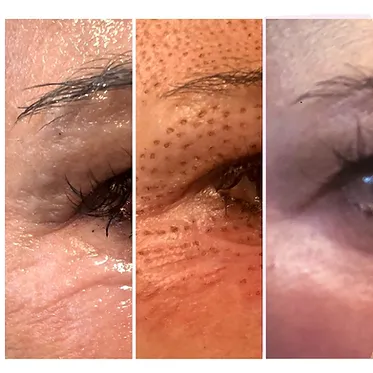 Woman Plazma-Pen Before and After Treatments Photo | SpaGo MedSpa in Erie, PA