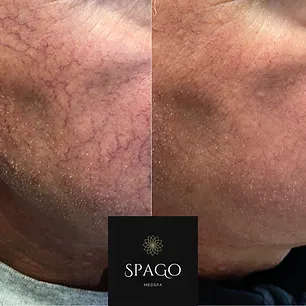 Client Rosacea Treatments Before and After Photo | SpaGo MedSpa in Erie, PA