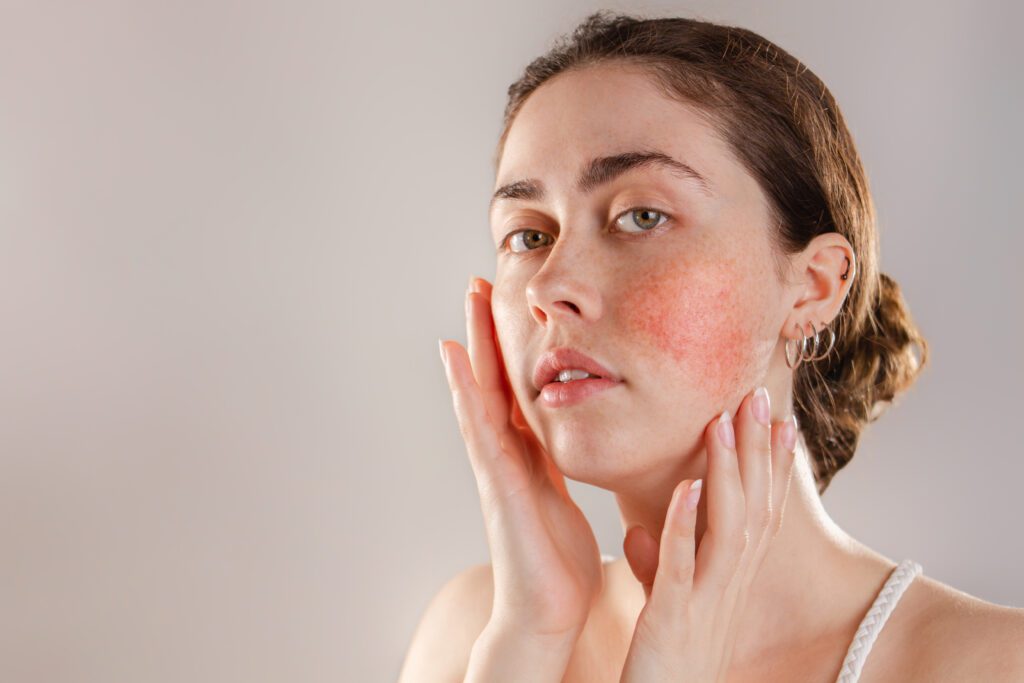 Portrait of a young woman showing rosacea on her cheeks with her hand | SpaGo MedSpa in Erie, PA