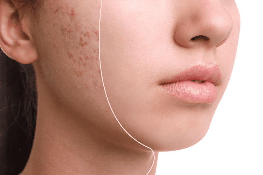 Young Girl Half Face with Radiesse | SpaGo MedSpa in Erie, PA