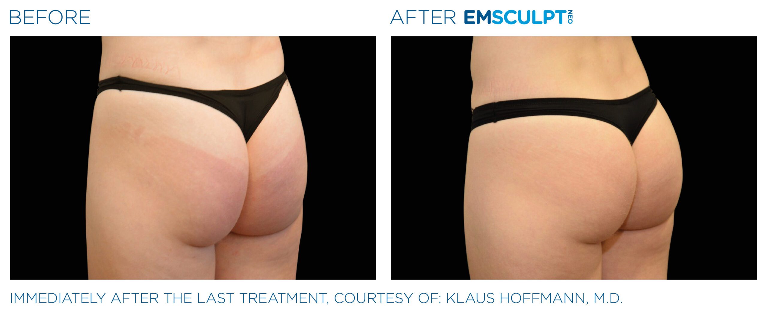 EmsculptNeobuttocks