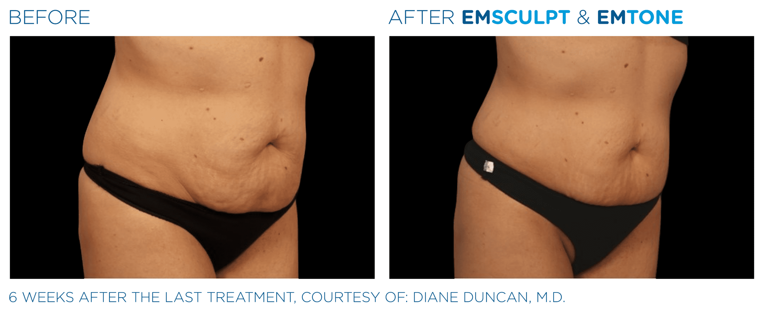 Emsculpt_Emtone_PIC_003_Ba-card-female-abdomen_ENUS100