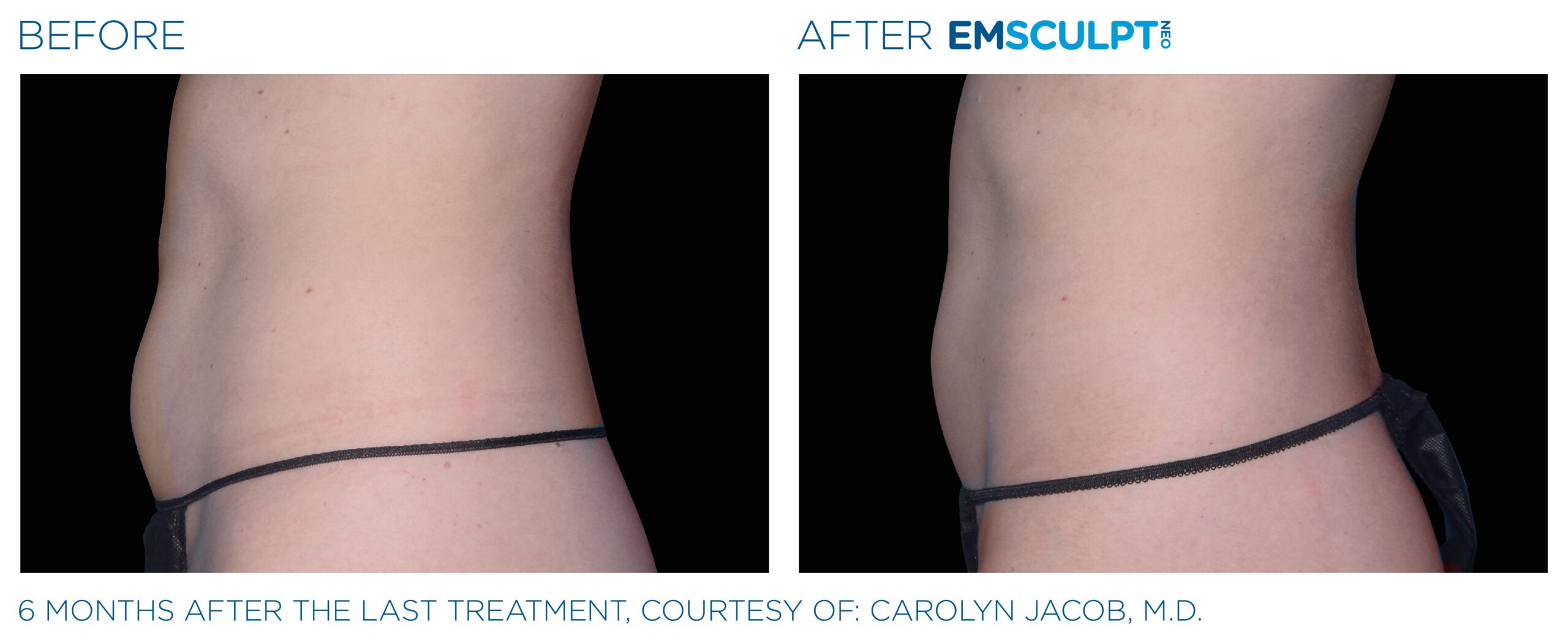 Emsculpt_neo_PIC_Ba-card-female-abdomen-041_ENUS100