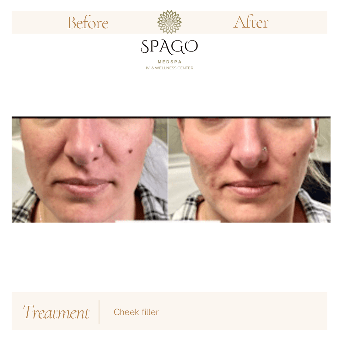 Dermal Fille B&A