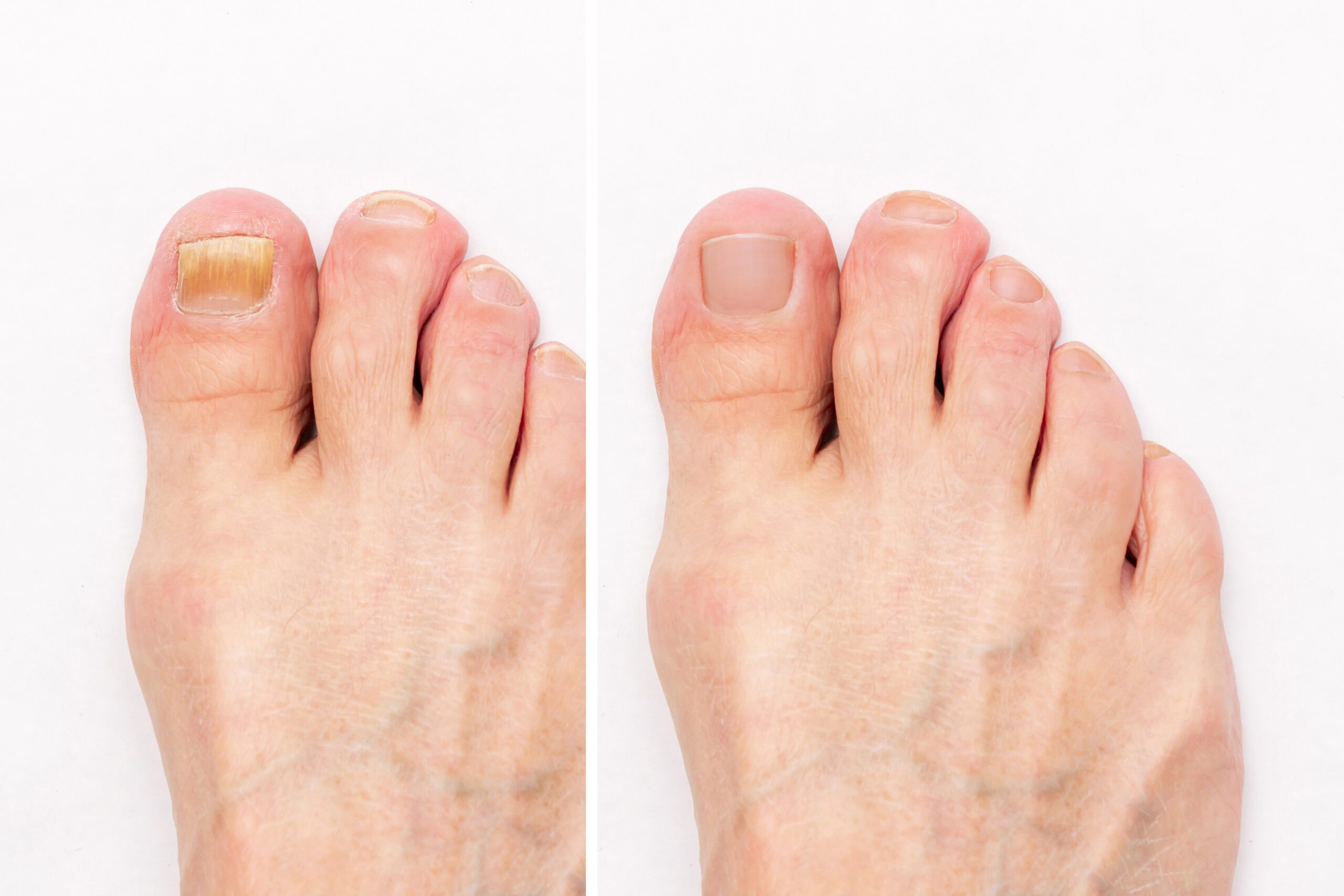 What are the Common Causes of Nail Fungus?