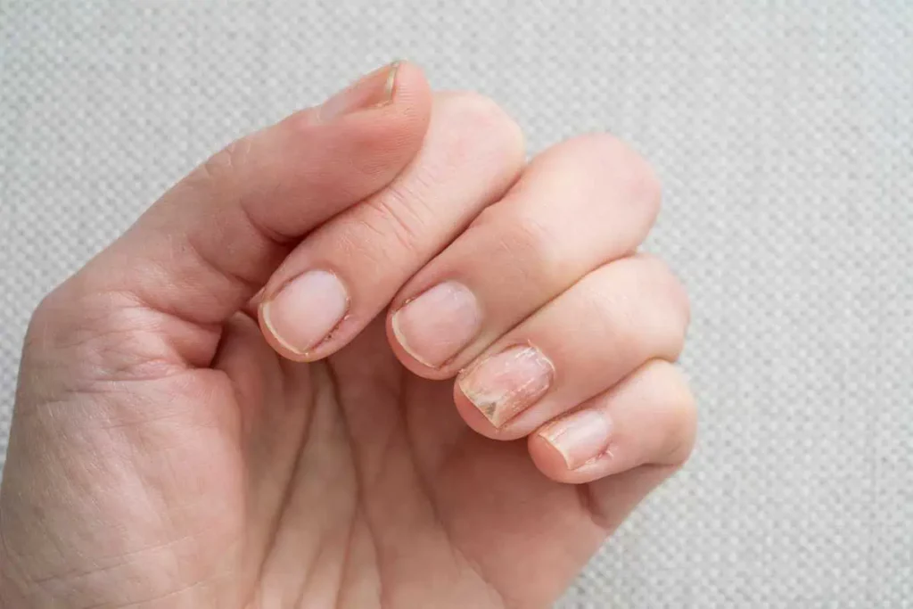 Nail Fungus Treatment by SpaGo MedSpa in Erie PA