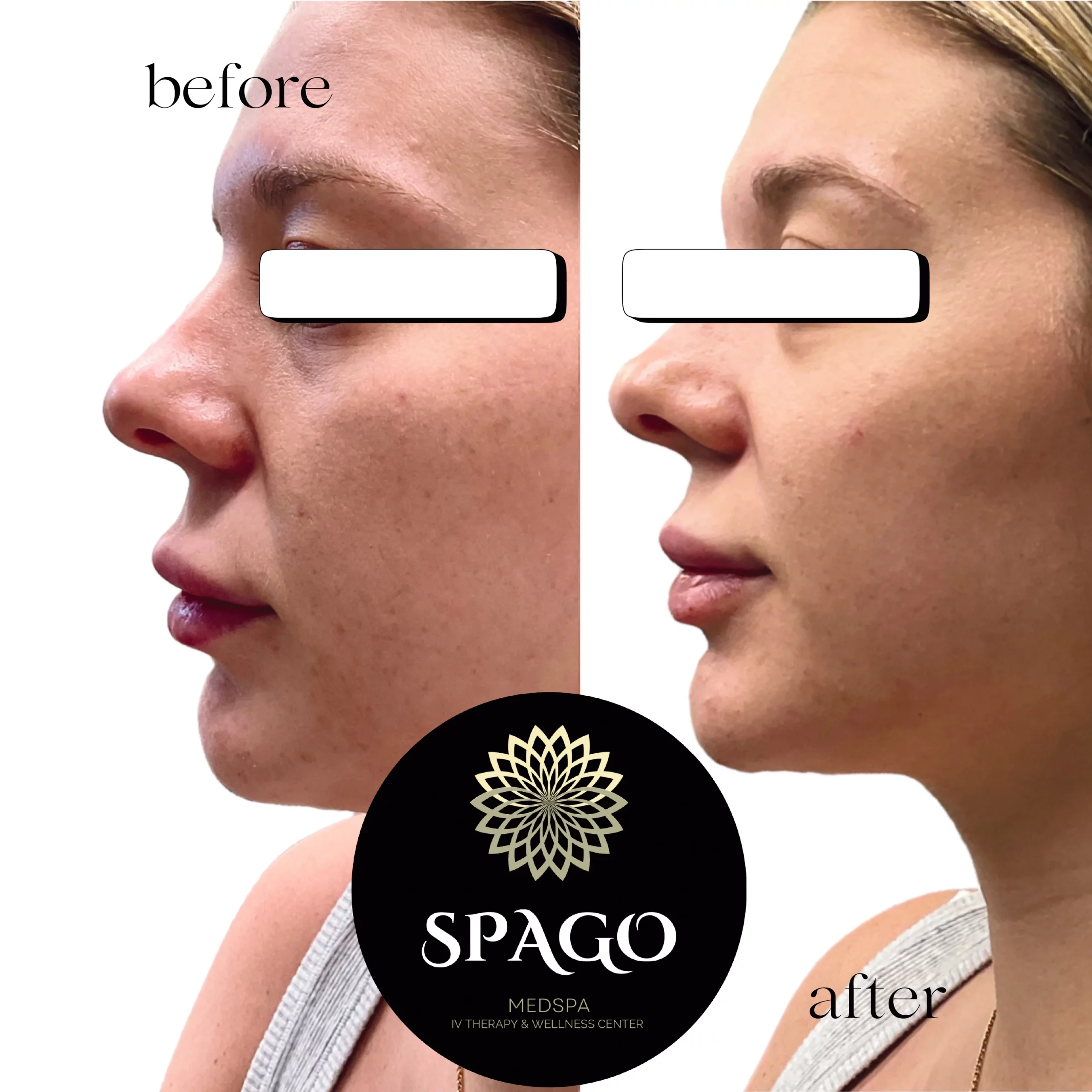 Before After cheeks and chin