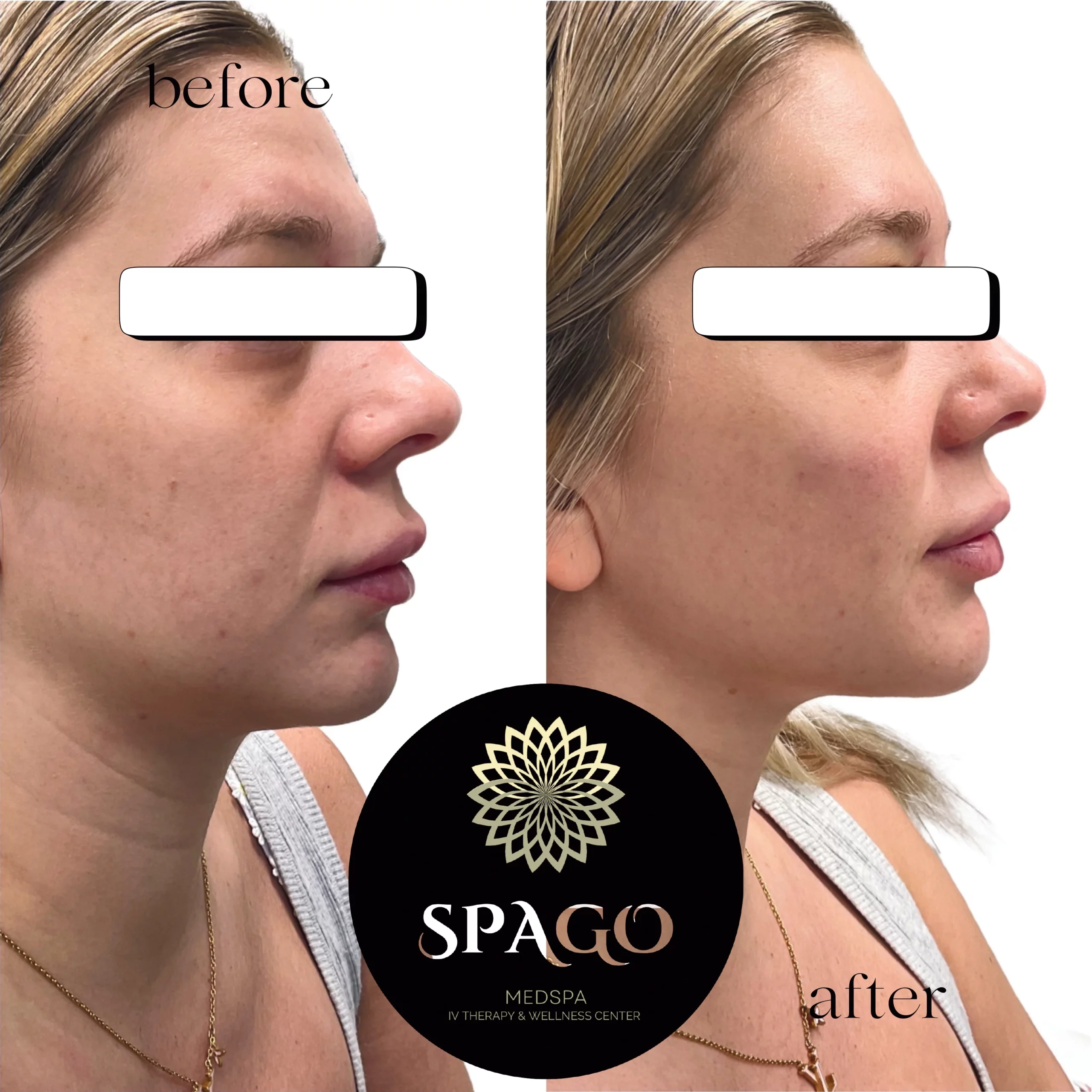 Before After cheeks and chin