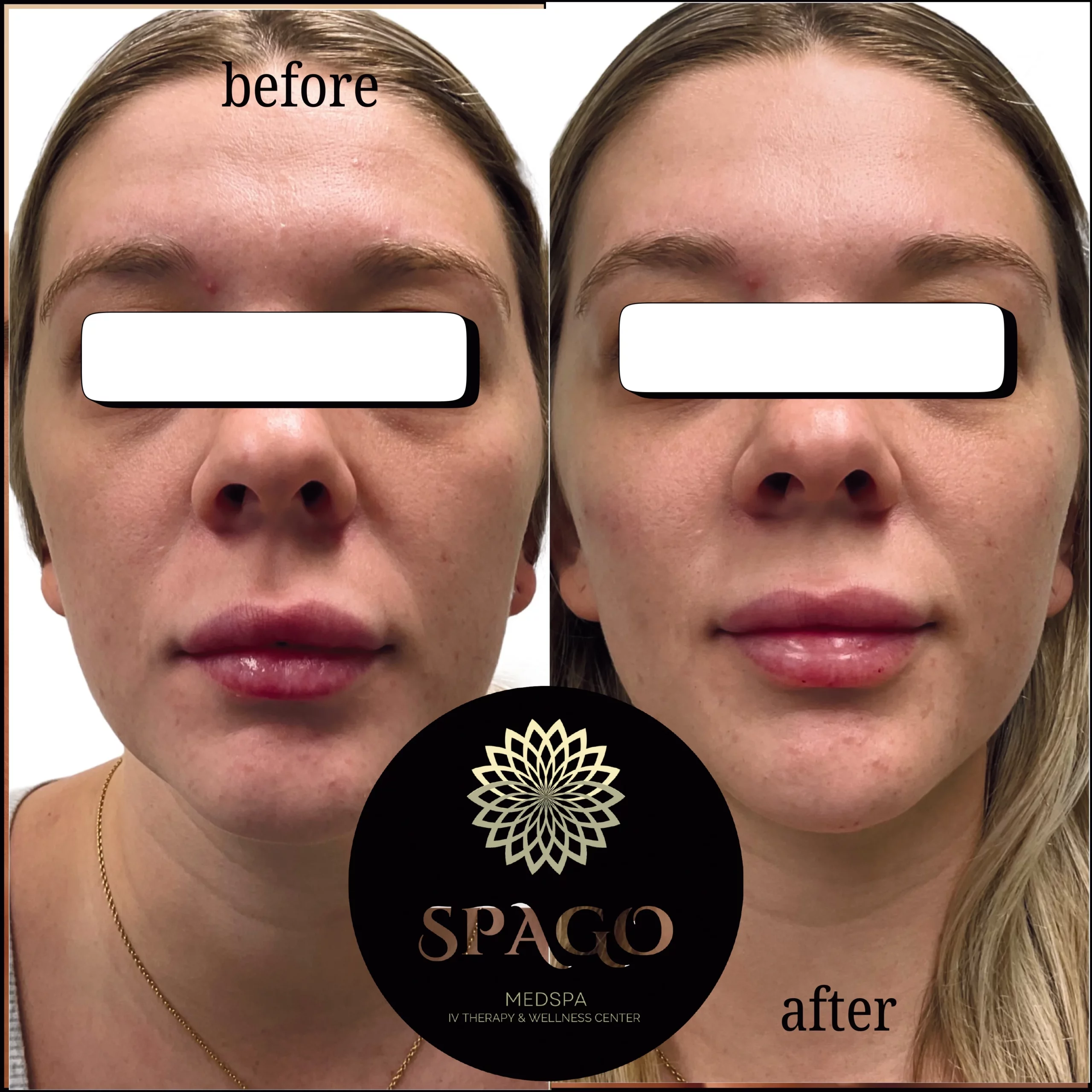 Before After cheeks and chin