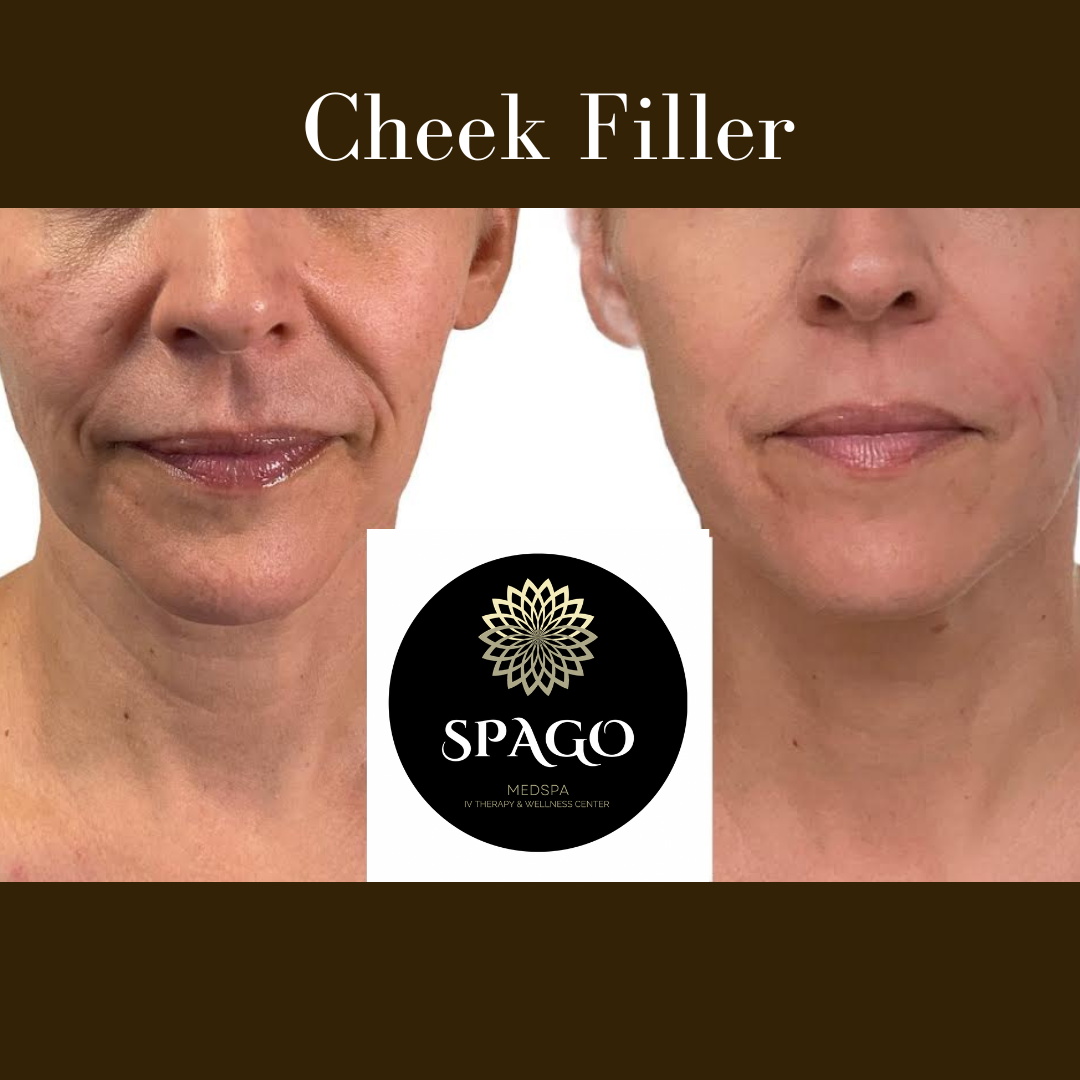 CHEEK FILLER (1)