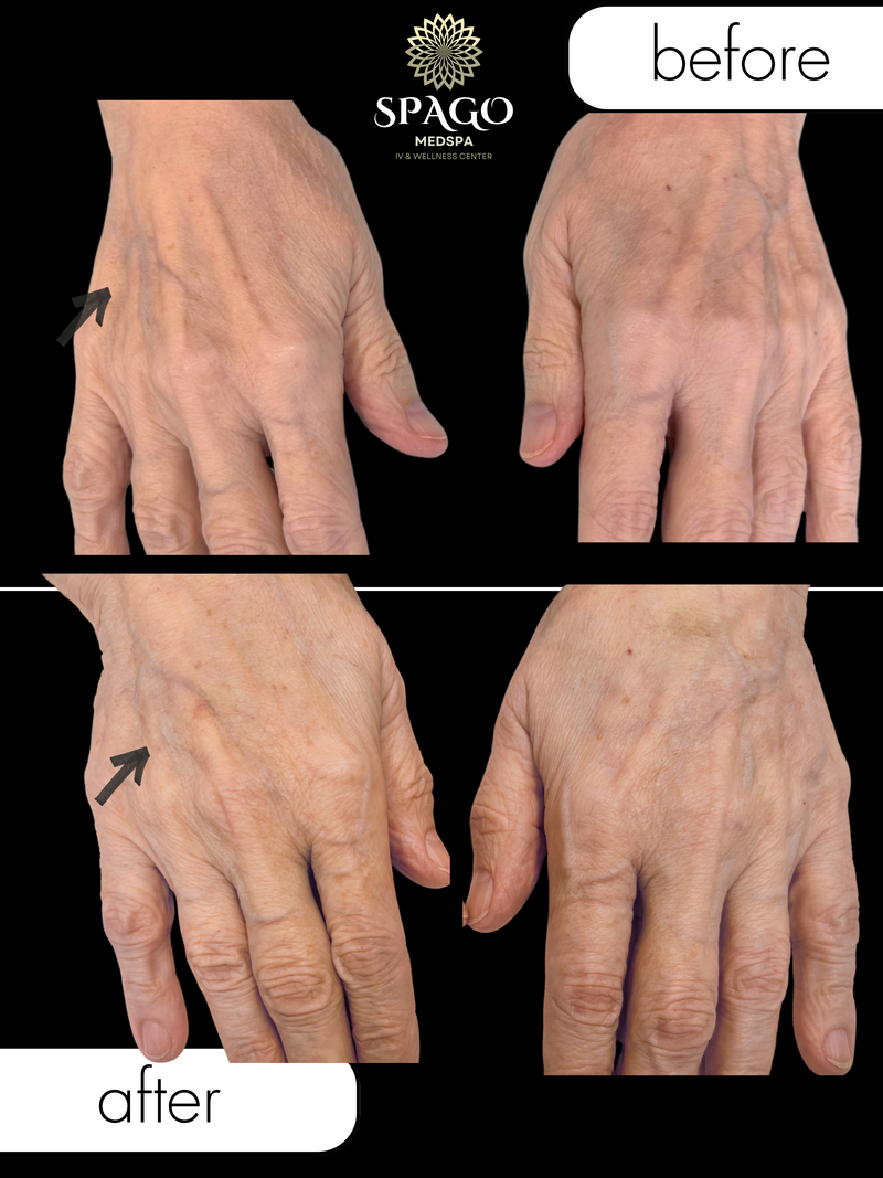 Hand filler (3) (1) (1)