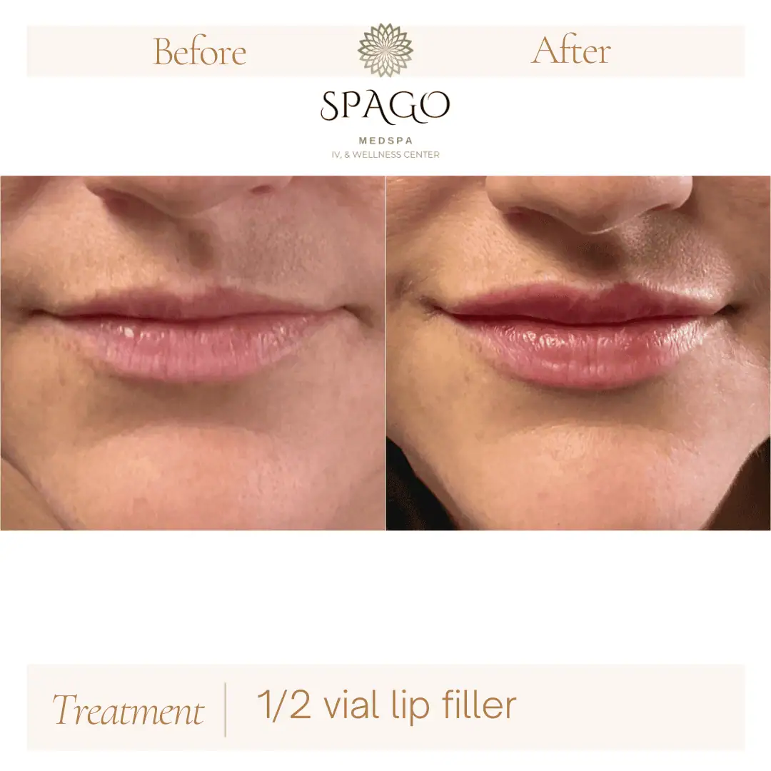Lip Filler Before & After (1)