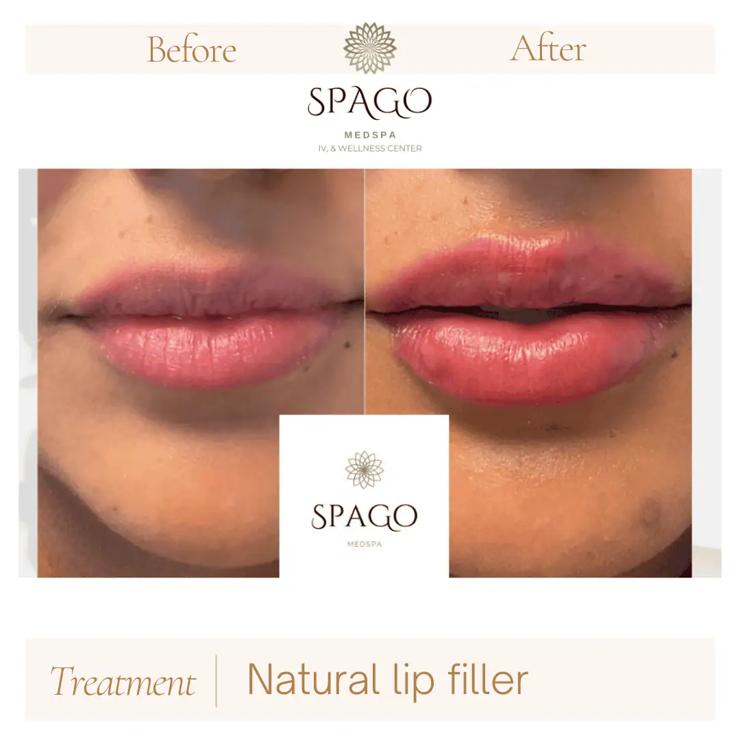 Lip Filler Before & After (10)