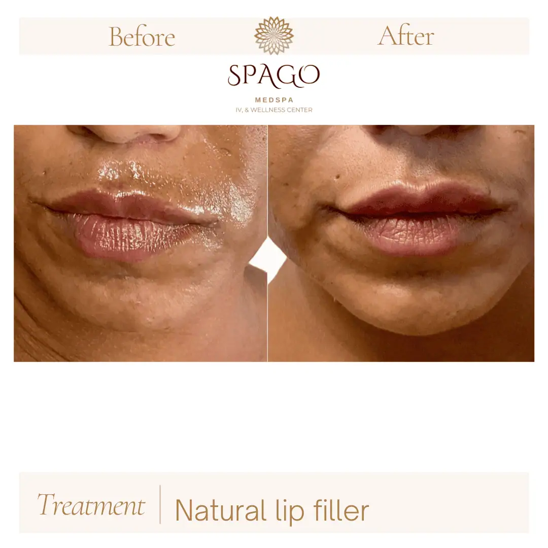 Lip Filler Before & After (11)