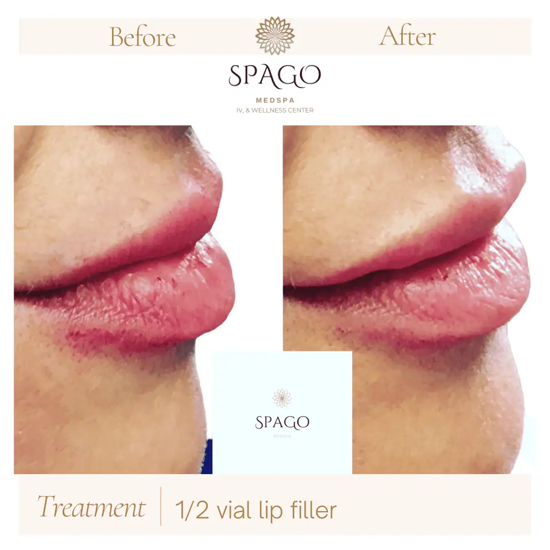 Lip Filler Before & After (12)