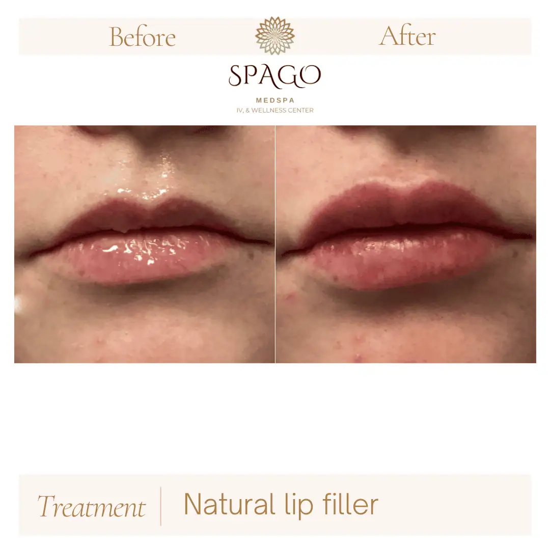 Lip Filler Before & After (13)