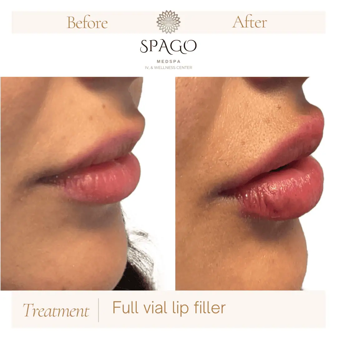 Lip Filler Before & After (14)