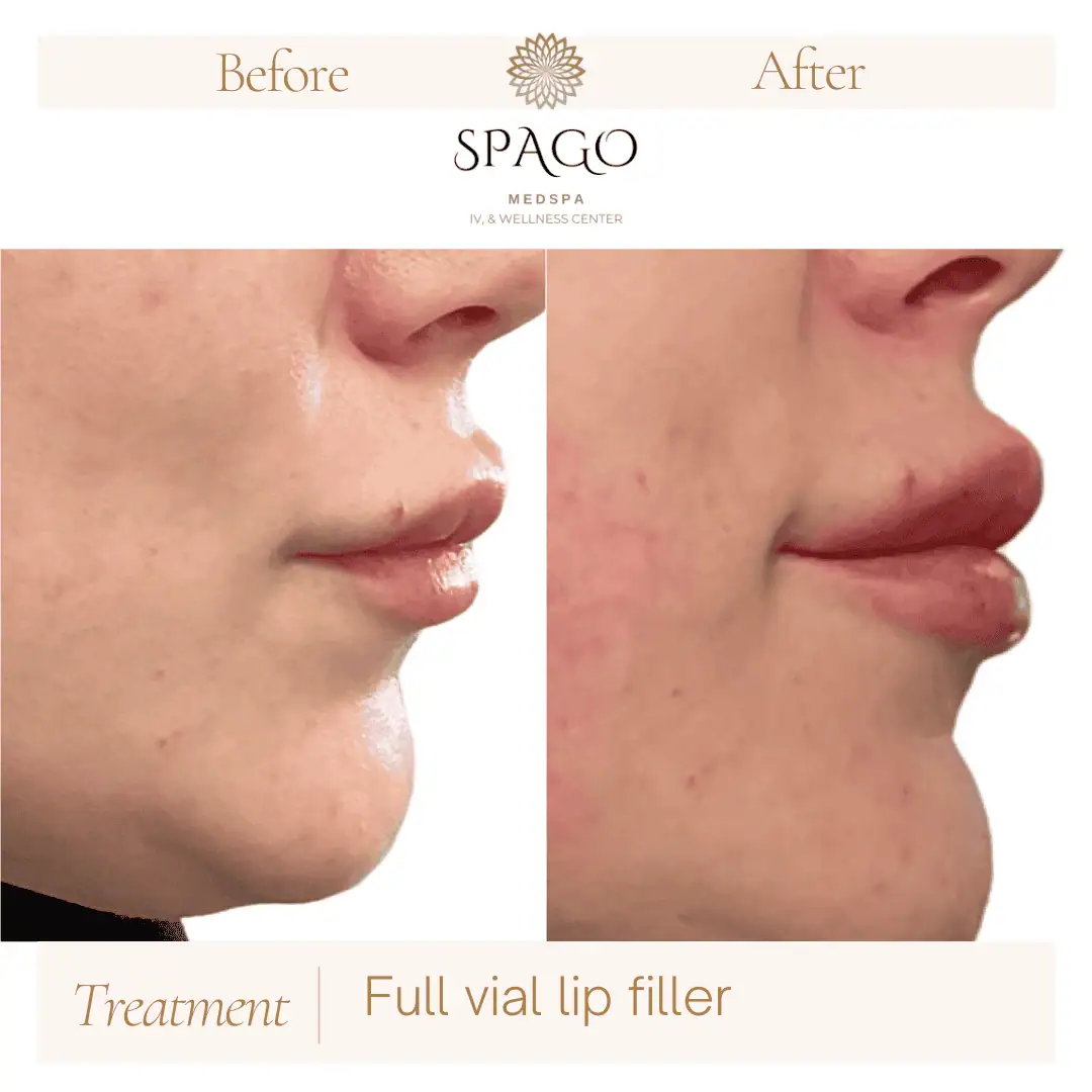 Lip Filler Before & After (15)