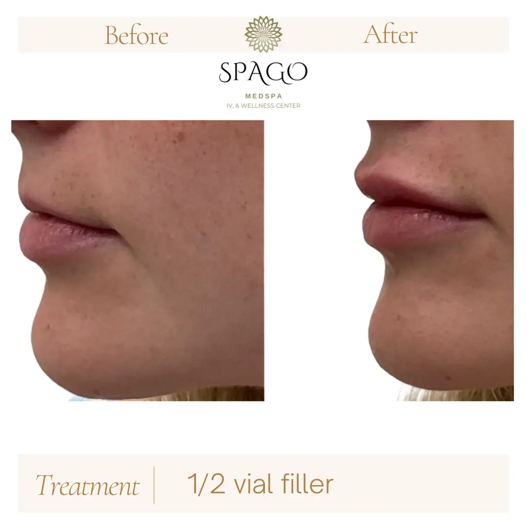 Lip Filler Before & After (16)