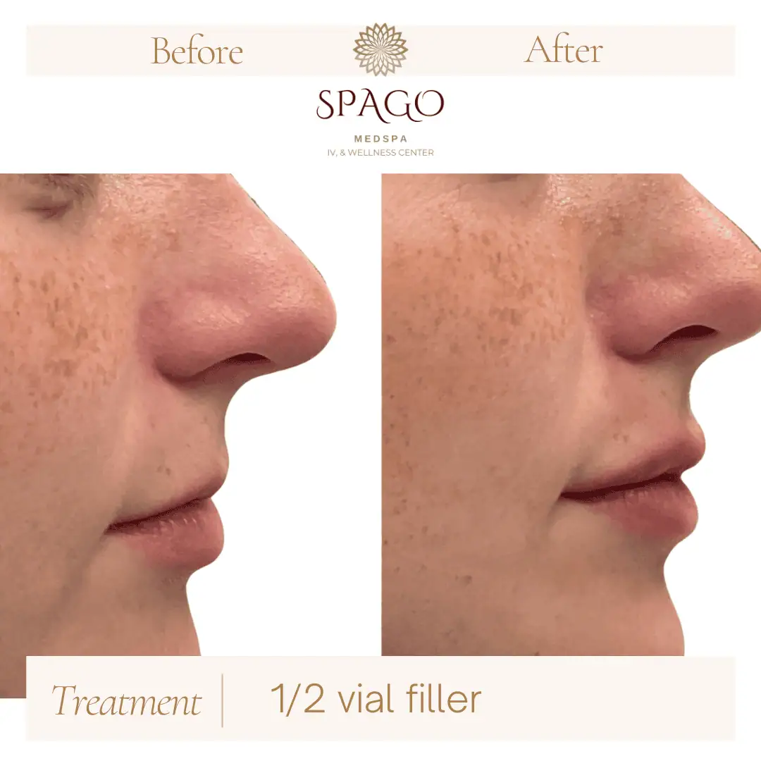Lip Filler Before & After (17)