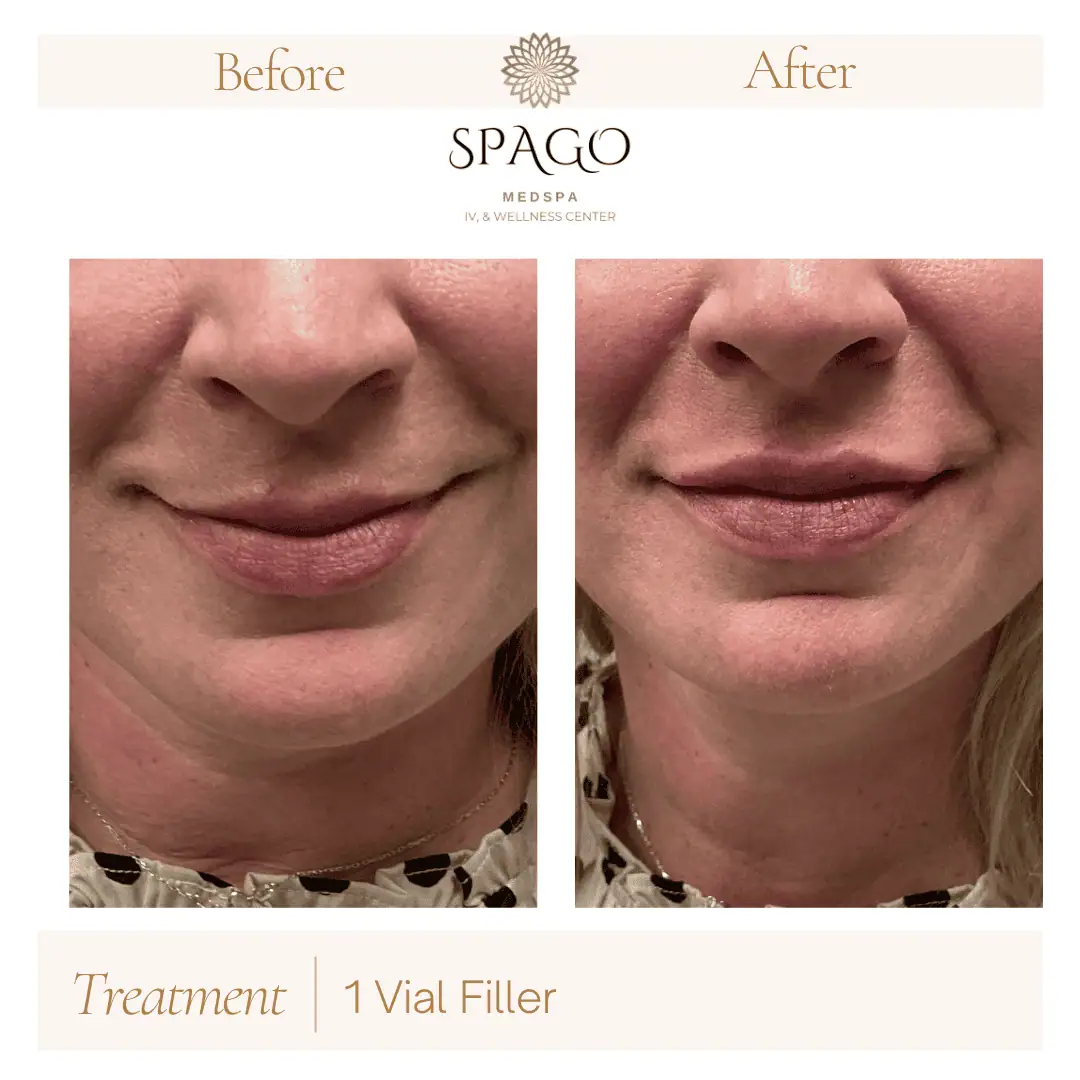 Lip Filler Before & After (18)