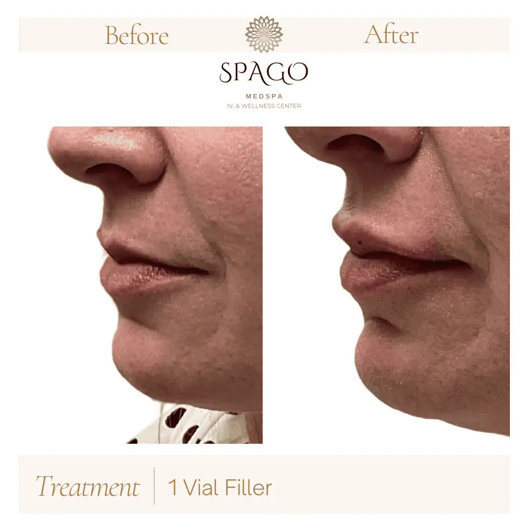 Lip Filler Before & After (19)