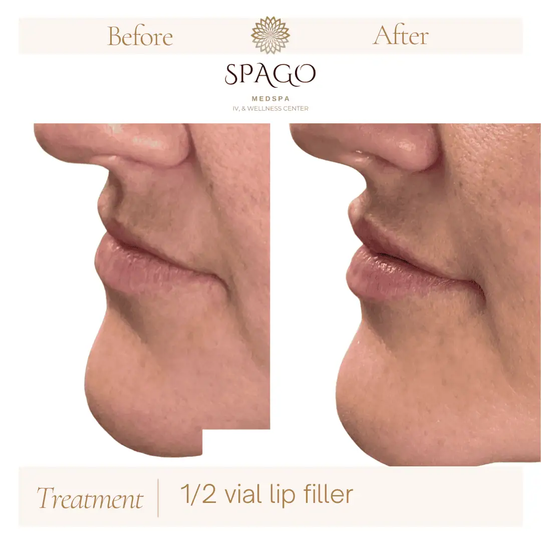 Lip Filler Before & After (2)