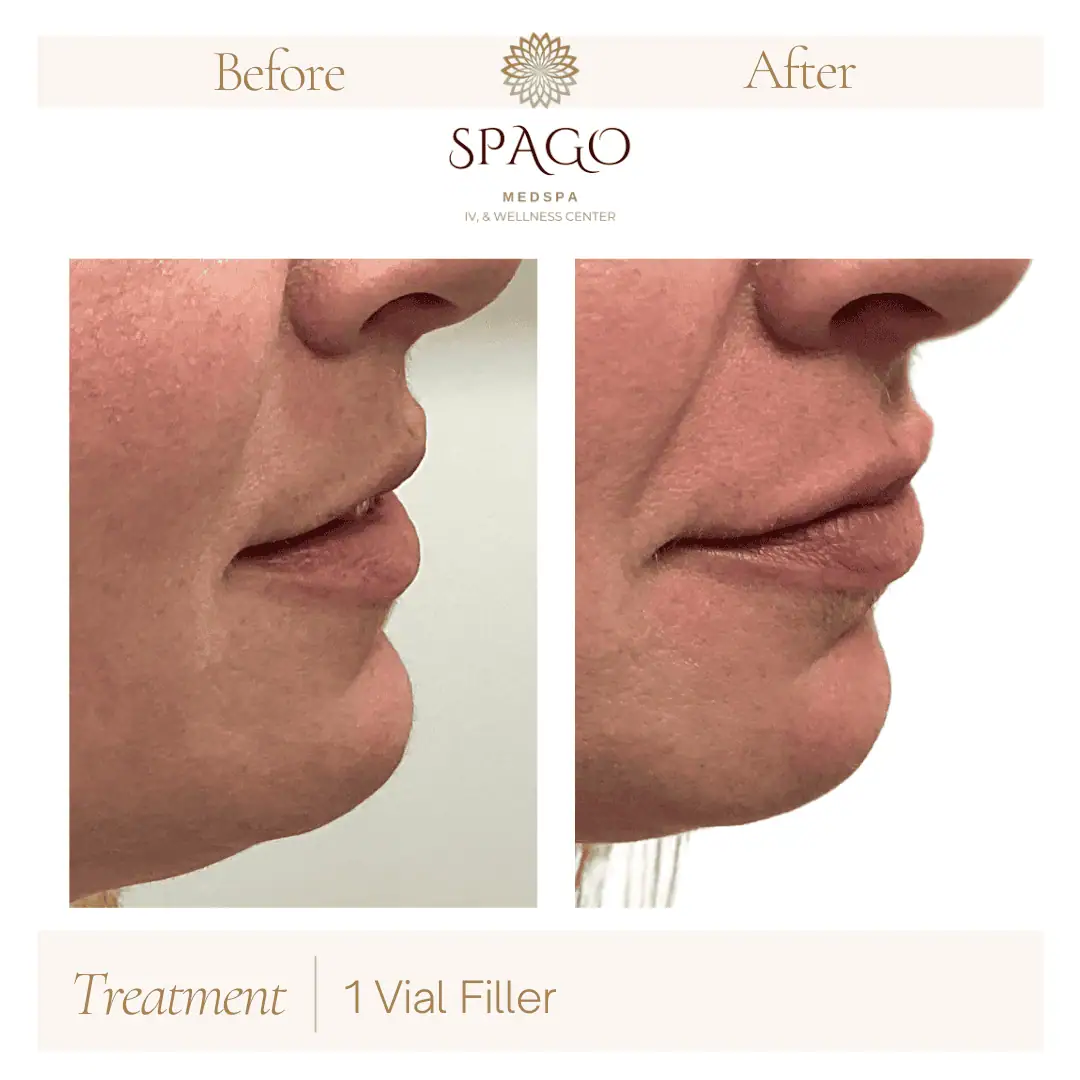 Lip Filler Before & After (20)