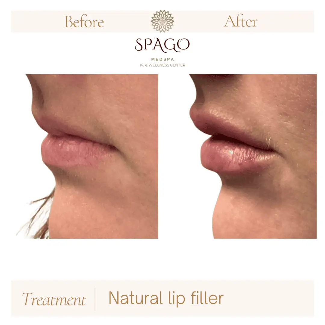 Lip Filler Before & After (21)