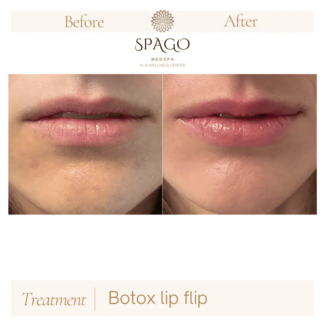 Lip Filler Before & After (22)