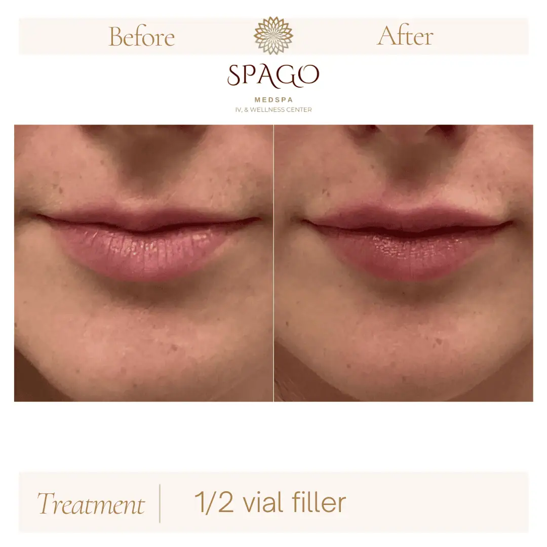Lip Filler Before & After (23)