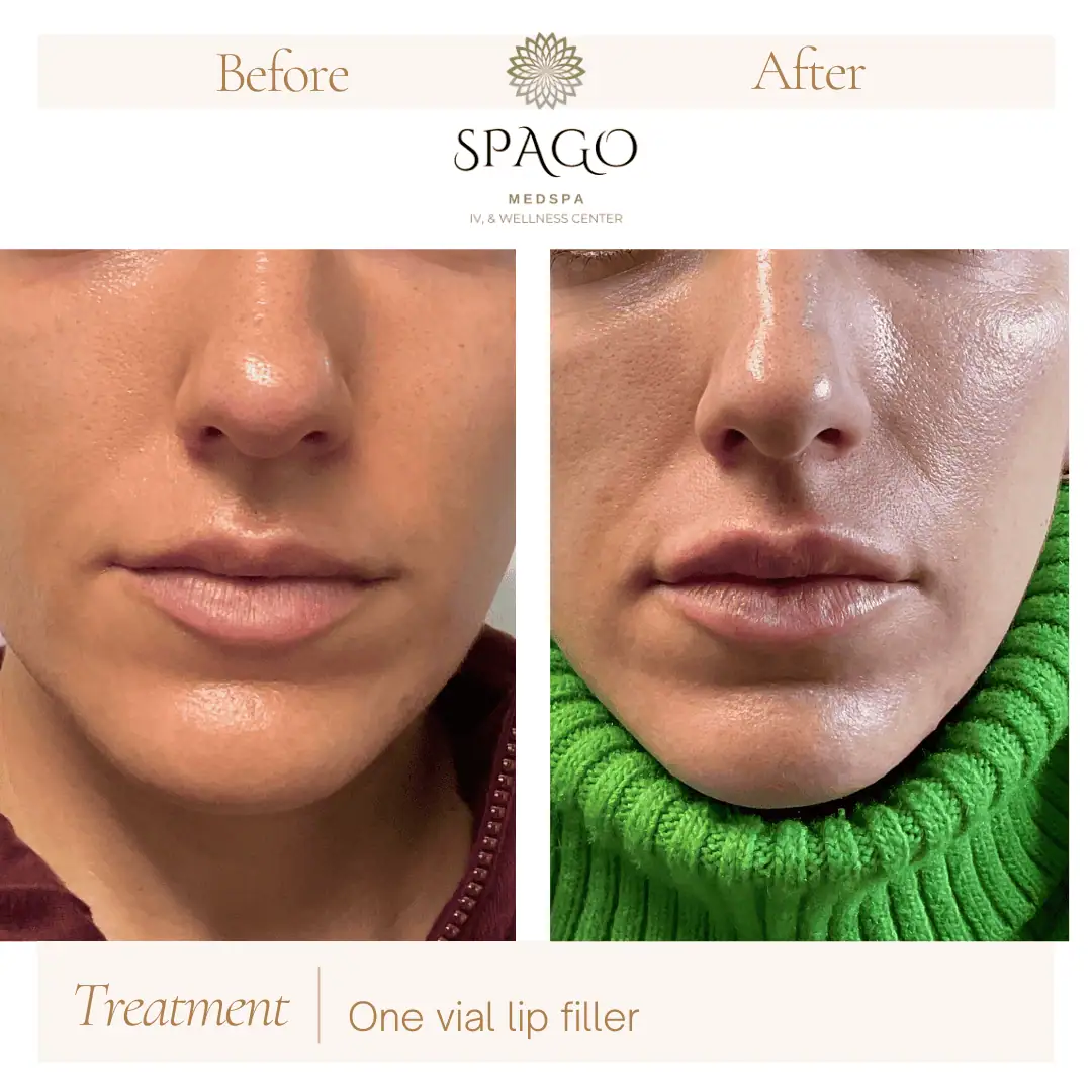Lip Filler Before & After (24)