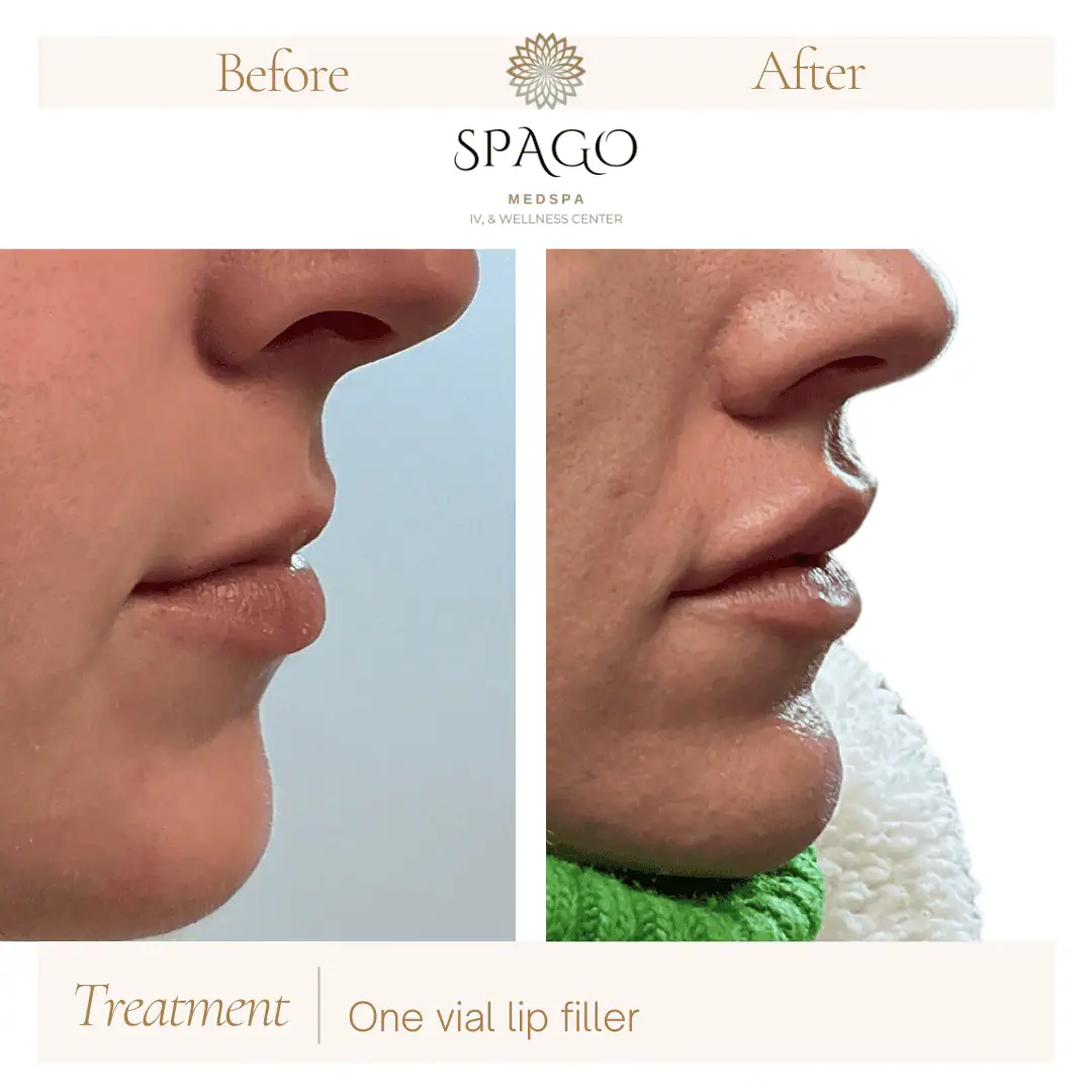Lip Filler Before & After (25)