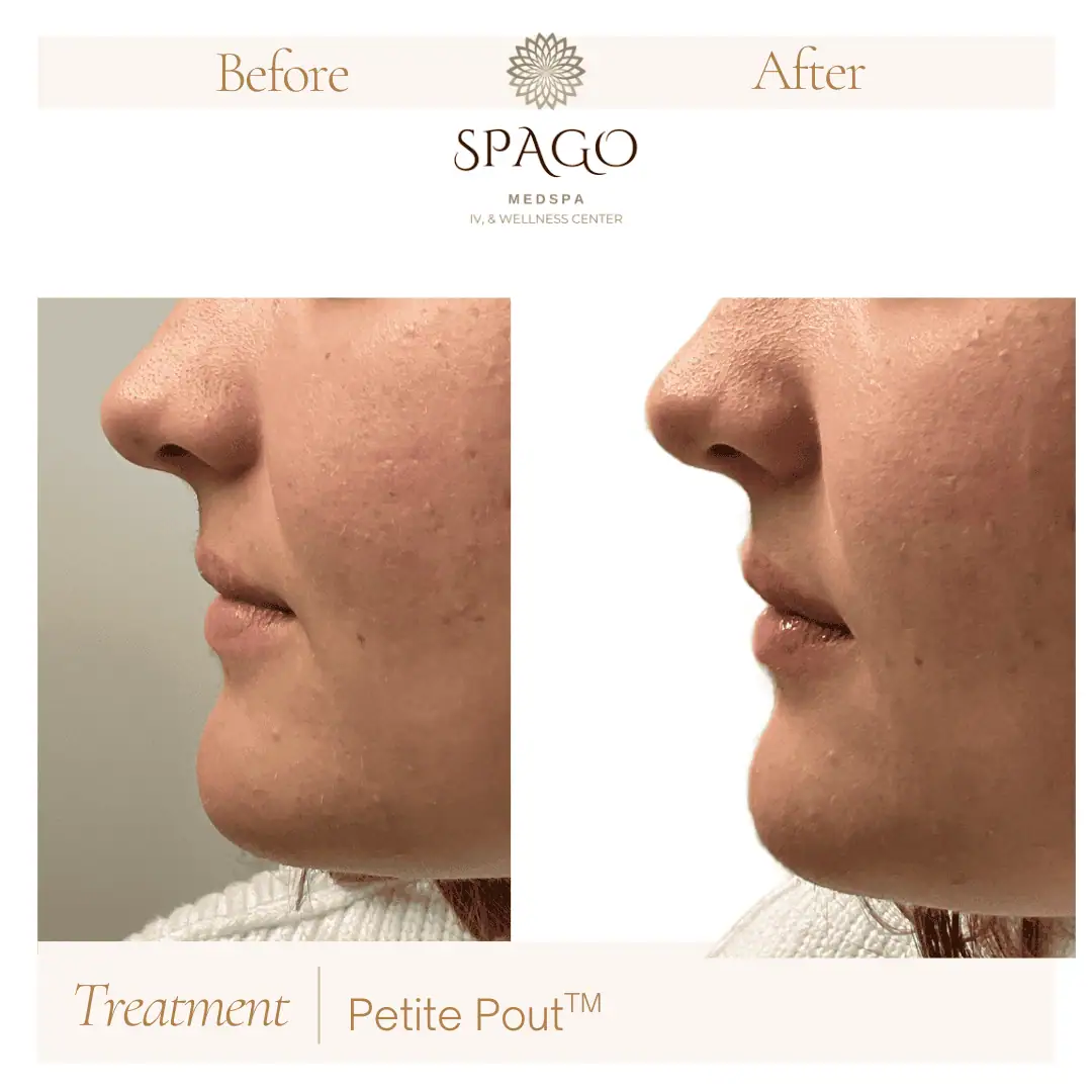 Lip Filler Before & After (26)