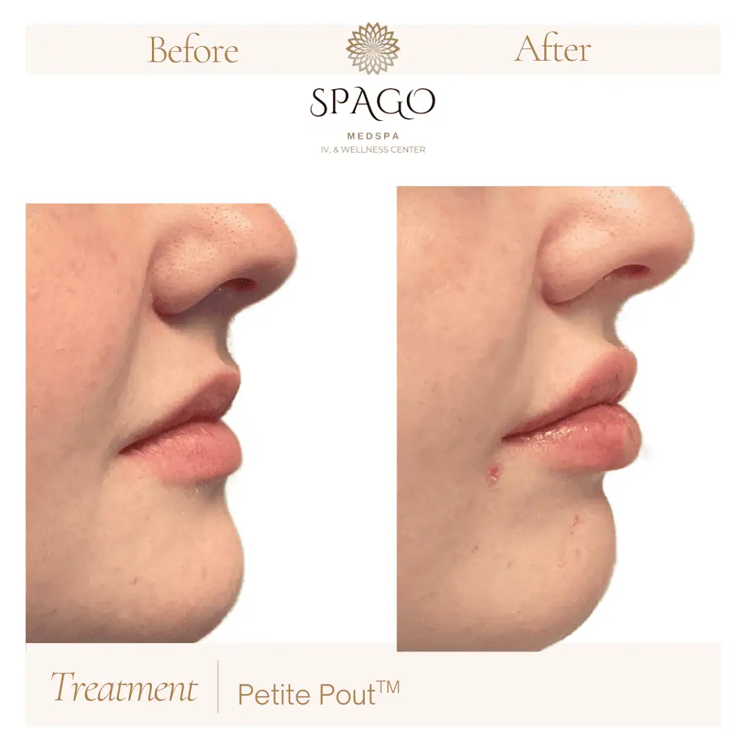 Lip Filler Before & After (27)