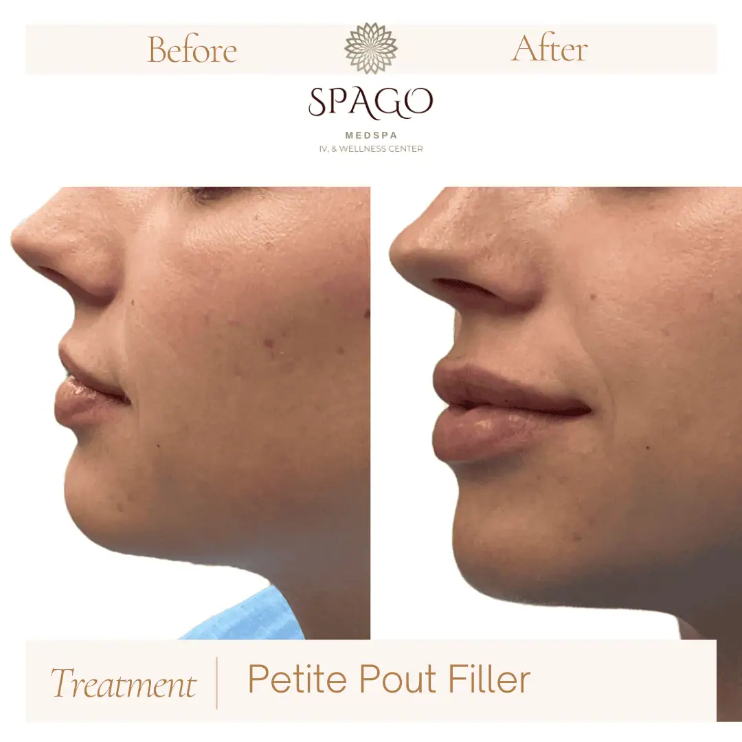 Lip Filler Before & After (28)