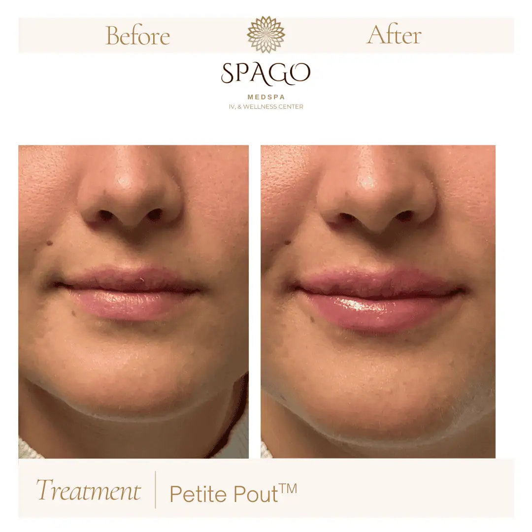 Lip Filler Before & After (29)
