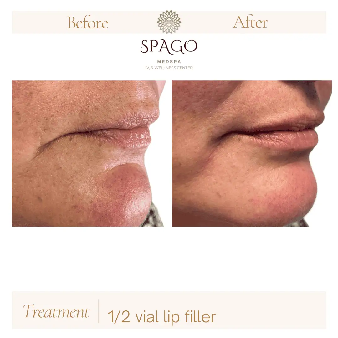 Lip Filler Before & After (3)