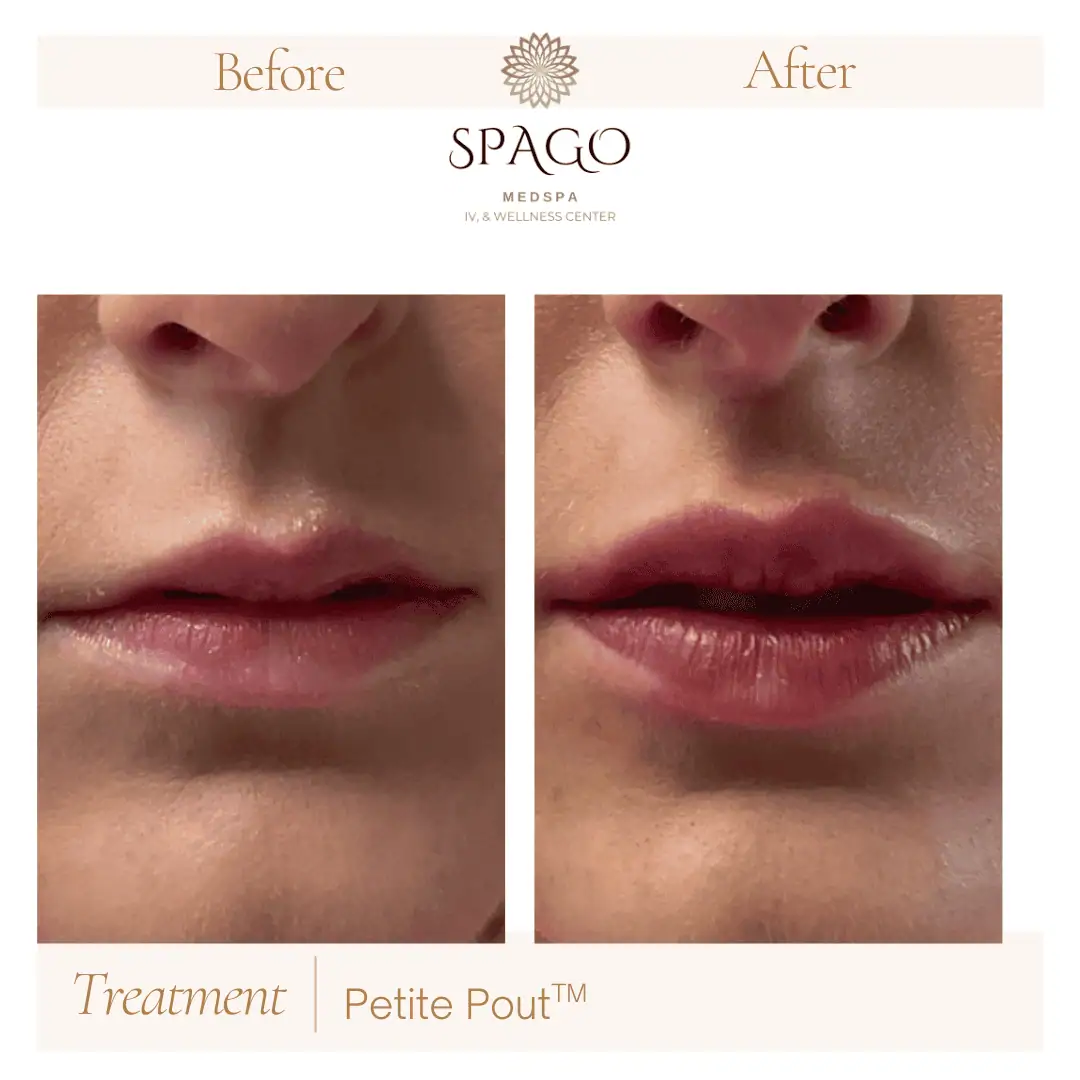 Lip Filler Before & After (30)