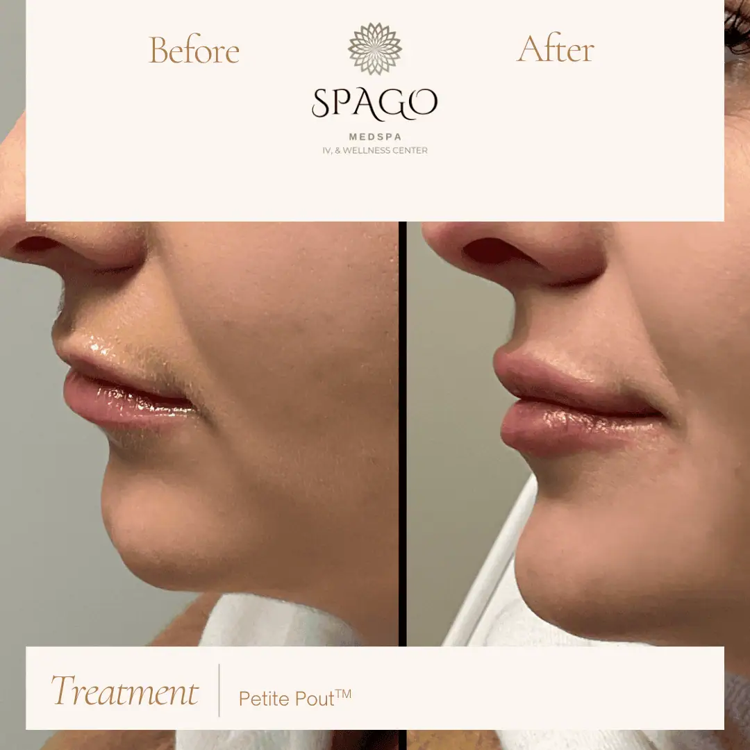 Lip Filler Before & After (31)
